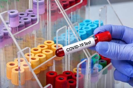 Ayeri 72 casos positivos de coronavirus